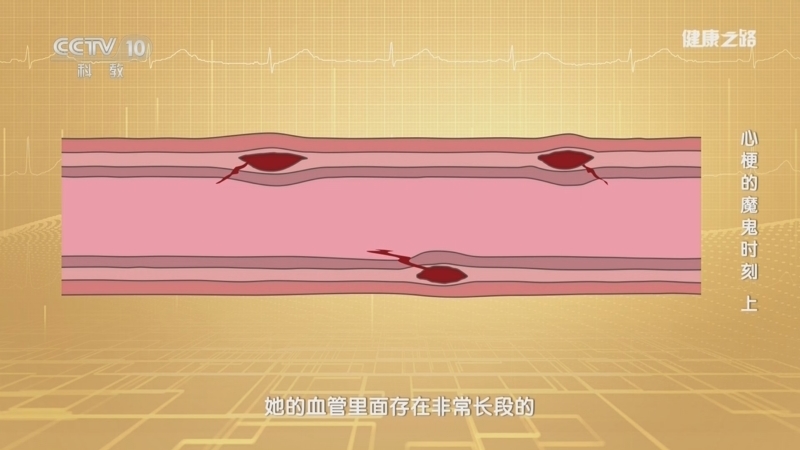 健康之路 《健康之路》 20240929 心梗的魔鬼时刻（上）