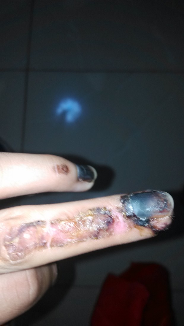 指甲带肉都被砸的分离,没有拔掉,指甲和肉还能长好吗.