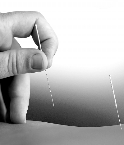 火针疗法:温通经络 调畅气血