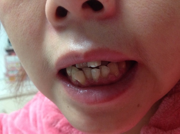 小孩牙龈萎缩图片图片