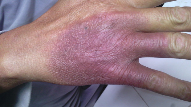 手背出现大面积紫色红肿,痒,一年会出现几次,这是什么症状?